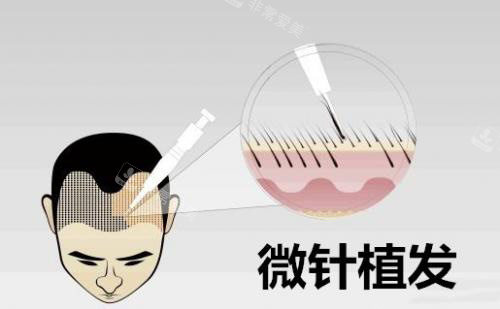 微针植发动画示意图 微针植发动画示意图