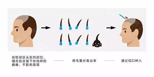 发际线移植手术过程示意图 发际线移植手术过程示意图