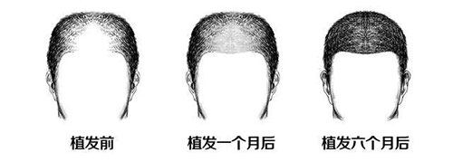 植发前后一个月对比示意图 植发前后一个月对比示意图