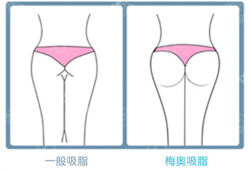 梅奥吸脂与一般吸脂对比图