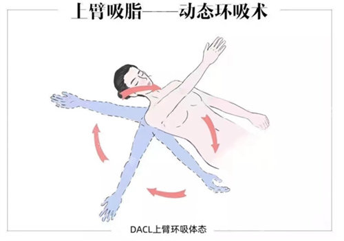 梅奥整形上臂吸脂展示图 梅奥整形上臂吸脂展示图