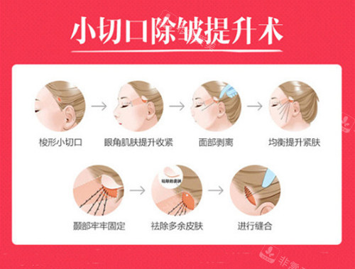 小切口提升术过程图 小切口提升术过程图