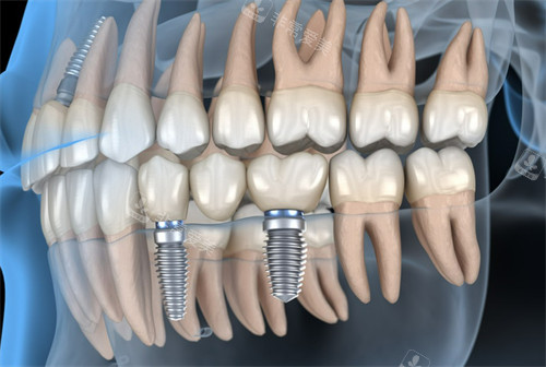种植牙动画展示图