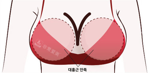 韩国普罗菲耳整形y型乳沟展示图