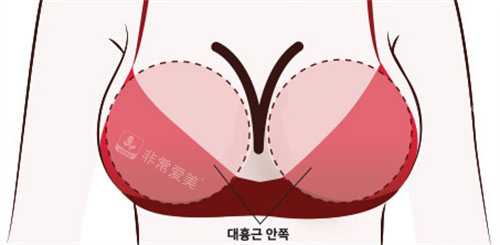 韓國普羅菲耳整形y型乳溝展示圖