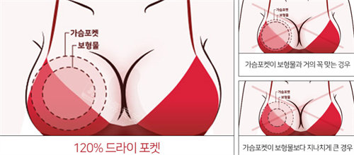 韓國普羅菲耳整形隆胸特色展示圖
