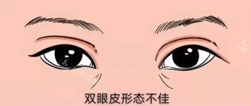 雙眼皮形態(tài)不佳示意圖 雙眼皮形態(tài)不佳示意圖