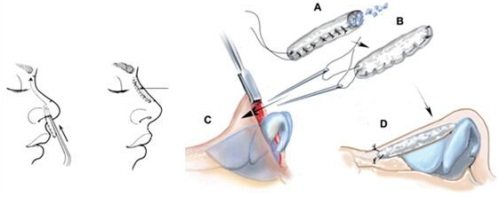隆鼻手術(shù)過程圖