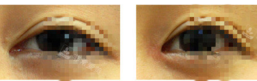 韩国EVE整形外科眼修复对比实例图