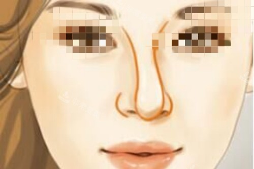 韩国VG百利酷整形外科提醒：隆鼻手术出现这些需要做修复！