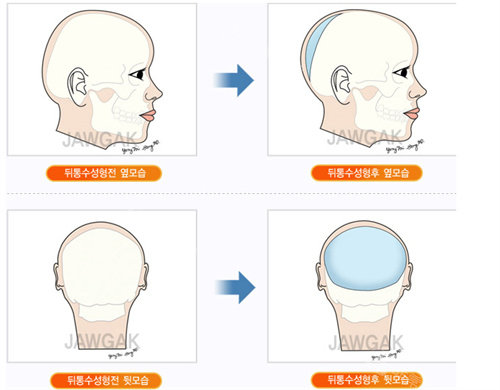 韩国雕刻整形外科后脑勺整形方法图