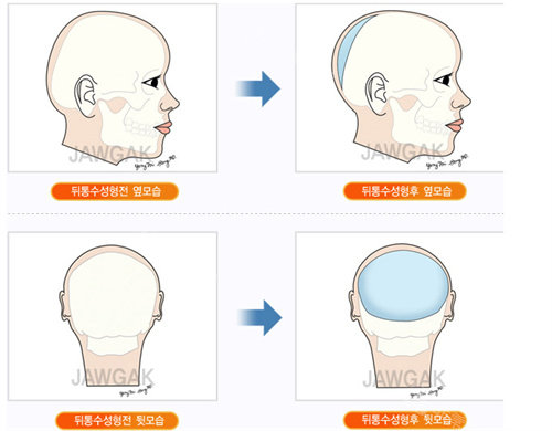 韓國(guó)雕刻整形外科后腦勺整形方法圖 韓國(guó)雕刻整形外科后腦勺整形方法圖