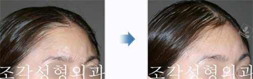 韩国雕刻整形外科颅顶整形对比图
