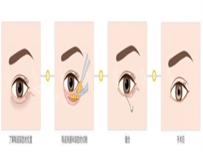 祛眼袋手术过程