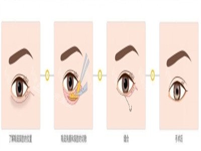 去眼袋整形手术多少钱？四问四答了解去眼袋手术