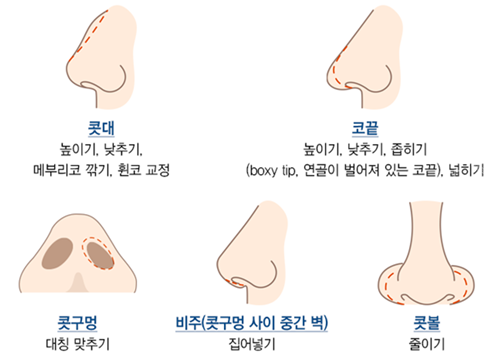 多种类型鼻子整形图示