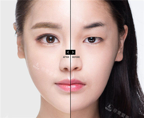 韓國dream整形眼部手術(shù)圖 韓國dream整形眼部手術(shù)圖