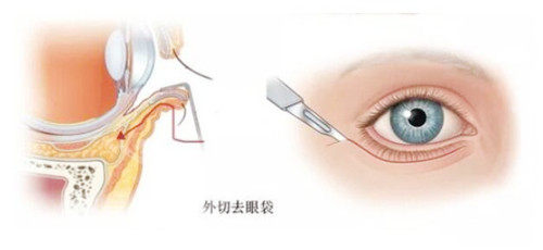 外切祛眼袋图示