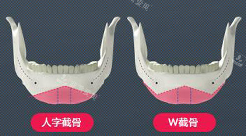 韩国NJH卢钟勋整形下颌角手术特点展示
