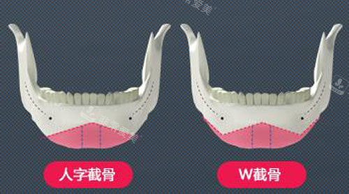 韓國NJH盧鐘勛整形下頜角手術(shù)特點展示