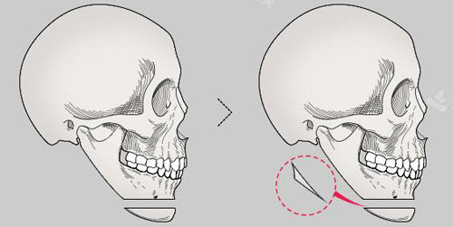 韓國(guó)NJH盧鐘勛整形墊下巴手術(shù)特點(diǎn)