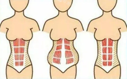 腹壁成形术肌肉收紧示意图