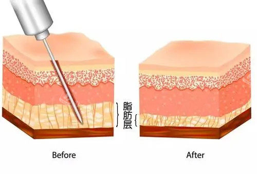 吸脂前后脂肪層次對(duì)比示意圖