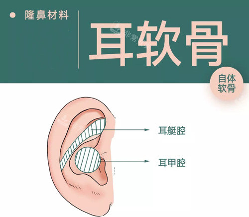 耳软骨隆鼻材料