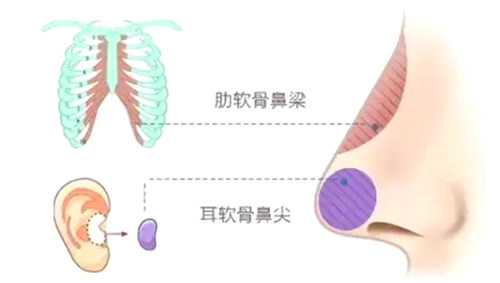 不同隆鼻材料填充圖示 不同隆鼻材料填充圖示