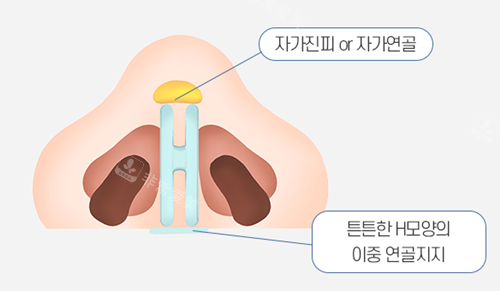 韓國溫度整形外科H型鼻子固定圖示 韓國溫度整形外科H型鼻子固定圖示