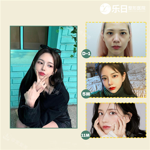 韓國樂日LARA整形外科鼻整形前后對比照