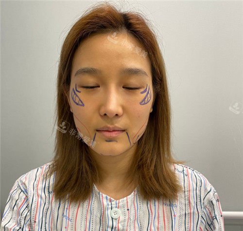 韓國(guó)1%整形輪廓手術(shù)設(shè)計(jì)圖