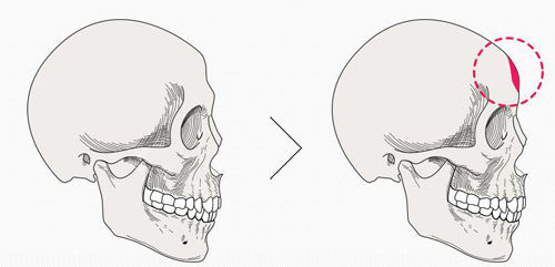 韓國NJH盧鐘勛整形外科假體墊額頭示意圖