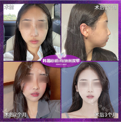 韓國(guó)必嫵整形醫(yī)院雙鄂手術(shù)前后圖 韓國(guó)必嫵整形醫(yī)院雙鄂手術(shù)前后圖