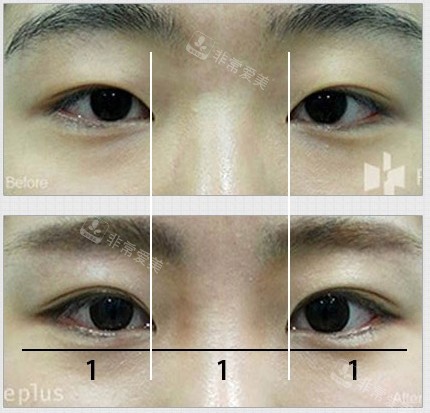 韓國(guó)Faceplus整形醫(yī)院開(kāi)內(nèi)眼角比例 韓國(guó)Faceplus整形醫(yī)院開(kāi)內(nèi)眼角比例