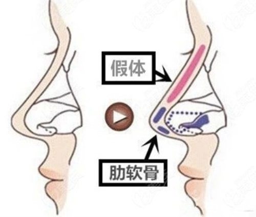 假體軟骨隆鼻示意圖