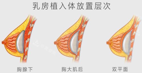 假體隆胸放置層次圖