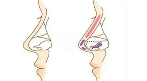 隆鼻假體放置位置展示圖