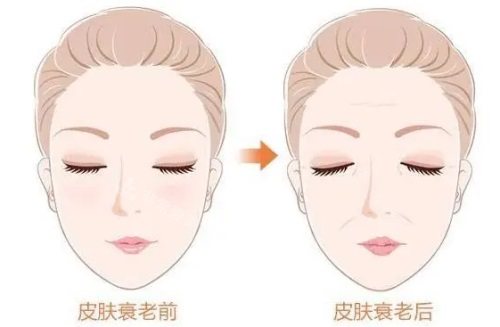 面部抗衰前后對(duì)比圖 面部抗衰前后對(duì)比圖