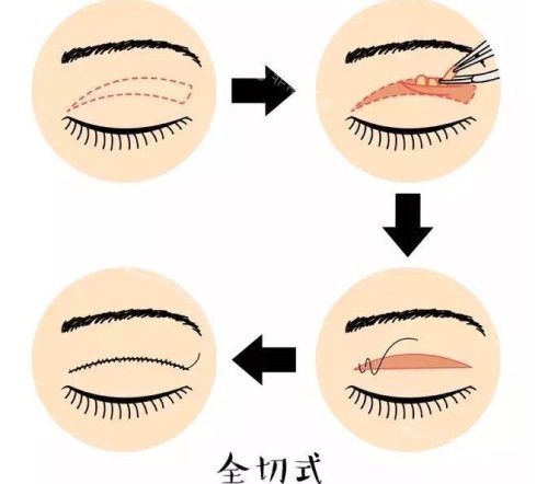 全切双眼皮示意图