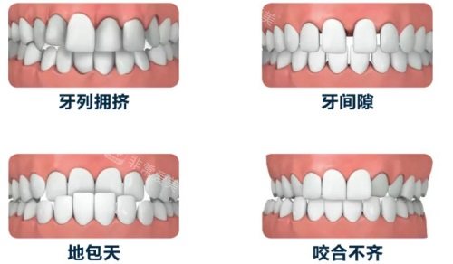 牙齿畸形示意图 牙齿畸形示意图