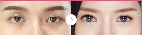 韩国大眼睛整形双眼皮手术