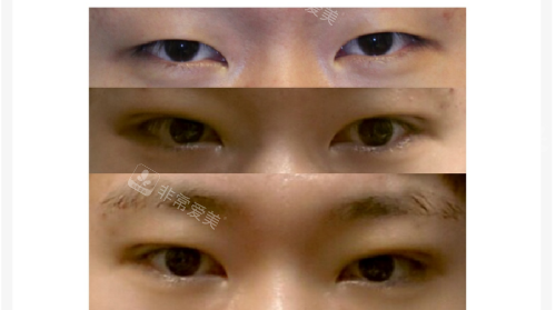 韩国大眼睛整形眼部整形对比