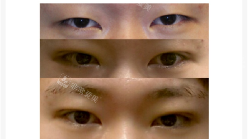 韓國大眼睛整形眼部整形對比 韓國大眼睛整形眼部整形對比