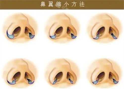 鼻翼縮小手術(shù)展示圖 鼻翼縮小手術(shù)展示圖