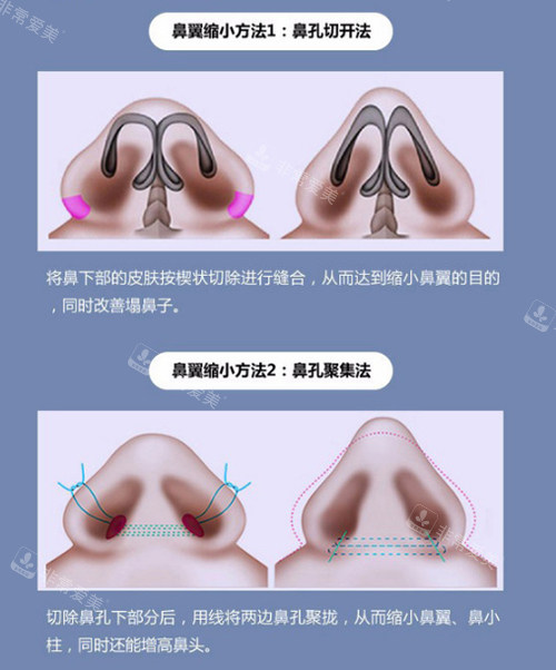 鼻翼縮小的方式展示 鼻翼縮小的方式展示
