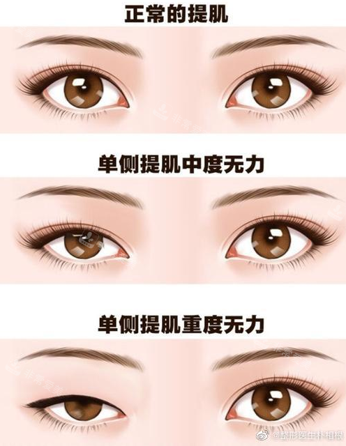 正常提肌跟眼肌無力癥狀對比 正常提肌跟眼肌無力癥狀對比