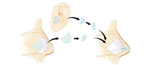 耳软骨隆鼻取材图示