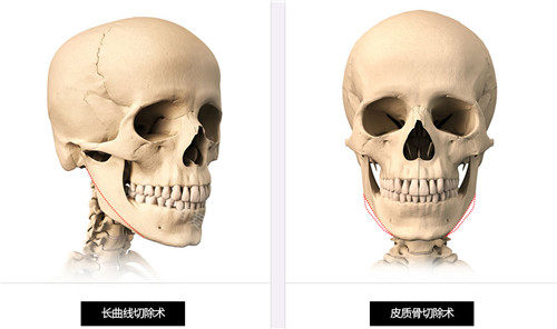 vline手術(shù)動畫演示圖
