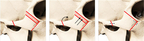 韓國(guó)夢(mèng)想整形顴骨整形方式圖